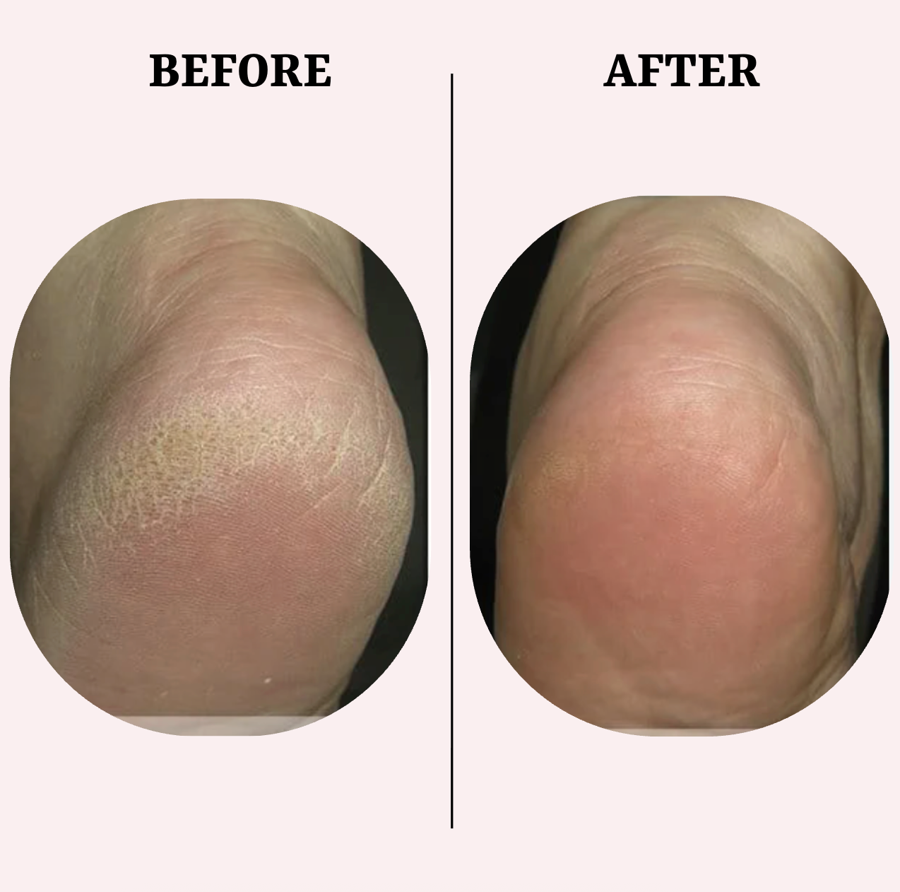 PediGlow™ Callus Remover