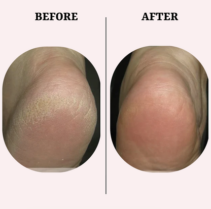 PediGlow™ Callus Remover